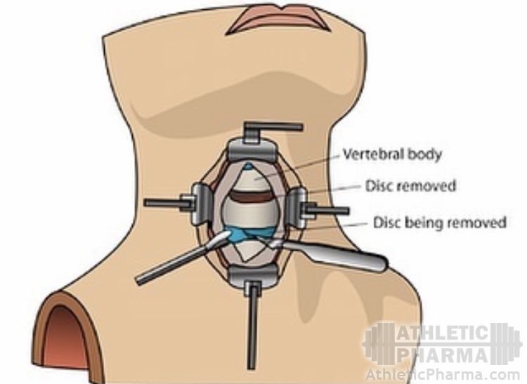 lee_priest_neck_operation.jpeg
